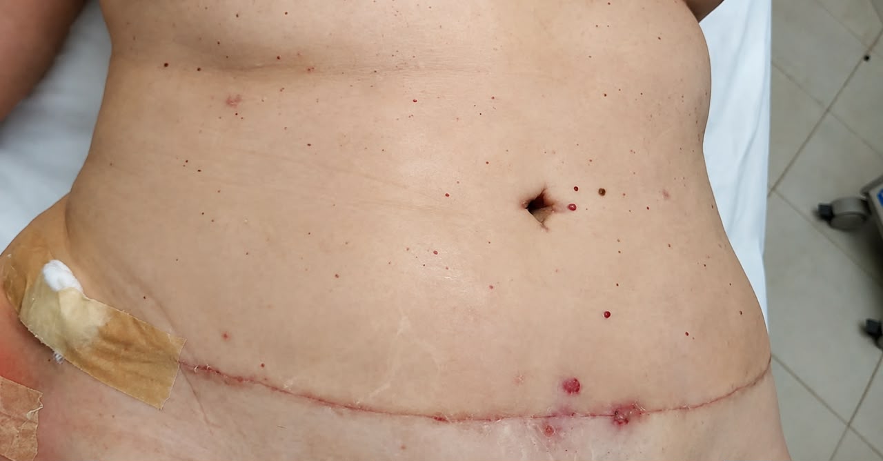 Antes do tratamento de pós-operatório na Clínica PIO